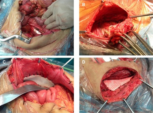 Figure 2 Intraoperative photos of the surgical process.