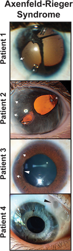 Figure 3. Axenfeld-Rieger Syndrome (ARS) and Iridogoniodysgenesis. Patients 1 and 2 have classic with posterior embryotoxon (white arrows) and iris hypoplasia leading to corectopia and pseudopolycoria. Both patients have superotemporal and inferornasal glaucoma drainage devices (asterisks). Patient 3 has prominent posterior embryotoxon (white arrows) and ectropion uvea with iris stromal atrophy (white arrowhead). Patient 4 has iridogoniodysgenesis associated with a FOXC1 mutation. The iris is hypoplasitic (black arrow) and a trabeculectomy with mitomycin C (black arrowhead) had previously been performed for glaucoma.