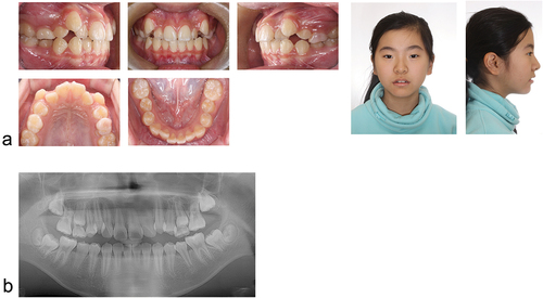 Figure 4. Initial intraoral and facial photographs (a), panoramic radiograph (b).