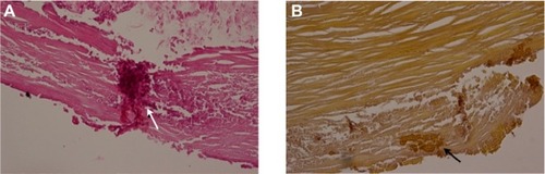 Figure 3 Calcified plaque of the superficial sclera following cosmetic ocular whitening.