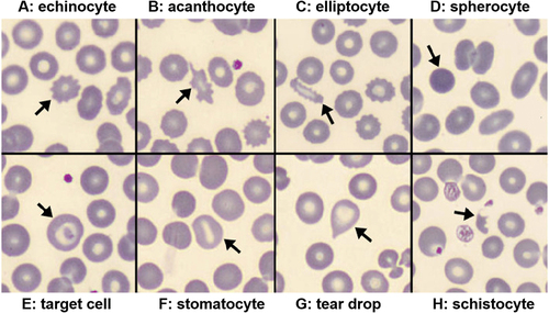 Figure 3. Typical abnormal RBC morphologies observed in the peripheral blood samples from COVID − 19 patients, adapted with permission from [Citation33]. Copyright 2022 Marchi, Bozzini, Bertolone, Dima, Busti, Castagna, Stranieri, Fratta Pasini, Friso, Lippi, Girelli and Vianello.