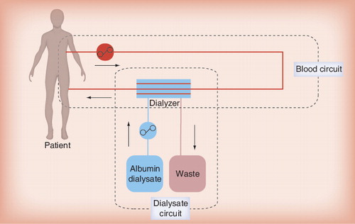 Figure 1. Single-pass albumin dialysis.