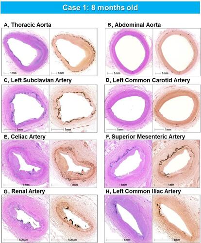 Figure 4 Representative histologic sections of the aorta and major branches with varying degrees of IEL fragmentation and calcification. Low-power images of the thoracic aorta (A), abdominal aorta (B), left subclavian artery (C), left common carotid artery (D), celiac artery (E), superior mesenteric artery (F), renal artery (G), and left common iliac artery (H) showing varying degrees of IEL fragmentation and calcificationLeft images are stained with hematoxylin and eosin stain and right images are stained with von Kossa stain. (A–H) are reproduced with permission from Federici et al.Citation58