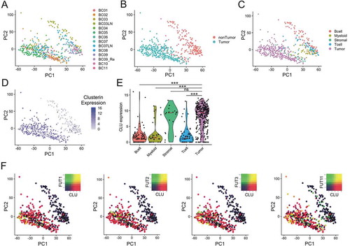 Figure 3. Single-cell analysis in breast cancer. Unsupervised principal component analysis (PCA) on the transcriptome of single-cell profiles (dots) colored by donor (a), cell tumor state (b) and cell type (c) showing the separation between tumor and non-tumor cells. D. Clusterin expression is dominant tumor cells. Unsupervised PCA of single-cell profiles with coloring of clusterin expression. E. Violin plots comparing clusterin expression based on cell types. Red lines show median expression for each group. P-values computed are pairwise Wilcoxon rank sum test comparing clusterin expression in tumor cells and other groups (*** = p < .001). F. Co-expression of Fucosyltransferases I, II, III and XI (FUT1, FUT2, FUT3 and FUT11) with clusterin in tumor cells is shown by PCA of single-cell profiles, showing clusterin expre ssion (red), FUT expression (green) and co-expression (yellow) or non-expression (black) of clusterin and FUTs.