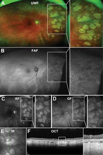 Figure 6. 87 year old Caucasian female with pavingstone degeneration. (A) UWF imaging demonstrates extensive lesions in the nasal retina which appear as (B) hypofluorescent lesions on FAF. (C) Red and (D) green-free images highlight the increased visibility of the choroid underneath lesions. (E) On infra-red imaging, pavingstone degeneration appears as hyporeflective lesions. (F) Peripheral OCT highlights thinning of the retina at lesions and subsequent increased choroidal visibility. Abbreviations as in Figure 3.