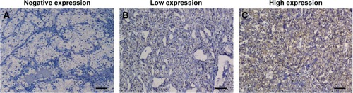 Figure 1 Representative images of immunohistochemical staining of ALDOA in ccRCC tissues.