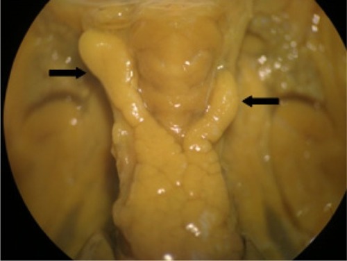 Figure 4 Visceral alteration in the fetus from a rat treated with vehicle.Notes: Misshapen thymus (arrow). Vehicle = 20 nM 4-(2-hydroxyethyl)-1-piperaz-ineethanesulfonic acid (HEPES) buffer containing 1% sodium citrate.