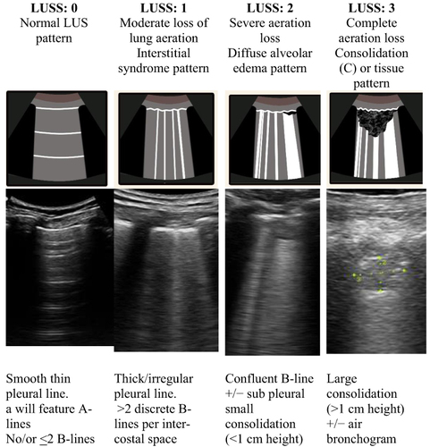 Figure 5 LUS score (LUSS) according to sonographic pattern: For each region, we allocated points, ranging from 0 to 3, according to the poorest ultrasound pattern observed. 0 = normal aeration, 1 = interstitial syndrome, 2 = alveolar edema, and 3 = consolidation. The final LUSS is the sum of the points in all 12 regions, which ranges from 0 to 36. Accordingly, the grading the disease severity index can be estimated: mild (score <5), moderate (<15), and severe (>15).