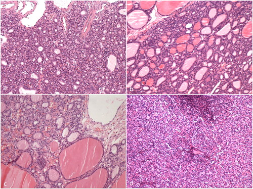 Figure 3. The pathology of the four patients with synchronous pseudo-Meigs’ syndrome and elevated serum CA125 level (HE staining, 100X). (a) Case 1; (b) Case 2; (c) Case 3; (d) Case 4.