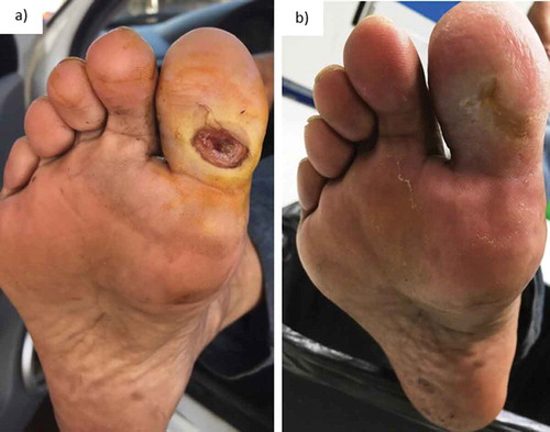 Figure 5. Chronological evolution of the ulcer in first toe of right foot. Initial appearance (a), ulcer at 37 days (b).