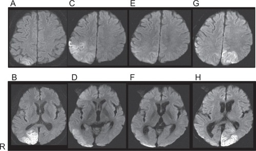 Figure 1 Brain magnetic resonance imaging (MRI) findings.