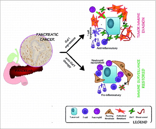 Figure 1. Role of Gal1 in stroma remodeling and immune escape in pancreatic cancer: implications in anti-Gal1 blockade therapy. Galectin-1 (Gal1) is highly expressed in the stroma of pancreatic tumors (see immunohistochemistry on the left). Gal1 promotes angiogenesis and is involved in pancreatic stellate cell activation and proliferation. Thus, Gal1 functionally contributes to the intense stromal reaction commonly occurring in pancreatic tumors (right, upper panel). Moreover, Gal1 impairs neutrophil recruitment and induces T-cell apoptosis, and favors a T helper type 2 (Th2) anti-inflammatory environment, thus resulting in tumor immune evasion (right, upper panel). Blocking Gal1 in pancreatic tumors hampers tumor progression by reducing angiogenesis, stromal activation and restoring immunosurveillance, leading to reduced tumor growth (right, lower panel).