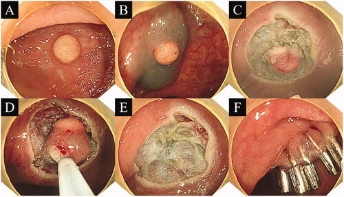 Figure 1. Procedure for precut endoscopic mucosal resection. (A) Yellow hemispherical mass in the rectum; (B) Injection into the submucosal layer; (C) Circumferential resection; (D) Snaring of the lesion; (E) Mucosal defect after endoscopic submucosal dissection; (F) Clip closure of the mucosal defect.