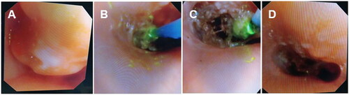 Figure 3. The bronchoscope image of a 15-month-old girl with severe pneumonia. Granulation and keloid proliferation at the site of tracheostomy. Severe subglottic scar contracture stenosis. (A) New granulation at the subglottic site of tracheostomy. (B-C) After expansion of airway airflow area, CO2 cryotherapy was applied to freeze the left granulation and keloid tissues for debridement. (D) Subglottic airway image after holmium laser ablation and CO2 cryotherapy.