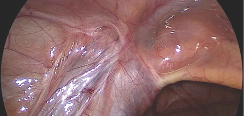Figure 1. Laparoscopic view of the left deep (internal) inguinal ring showing the vas and vessels entrapped in dense adhesions.