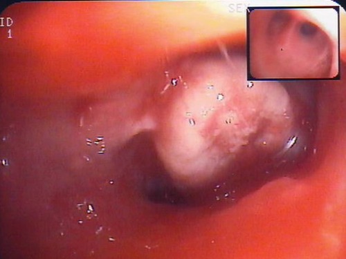 Figure 2 Bronchoscopy showing a whitish polypoid lesion consistent with carcinosarcoma at histology.