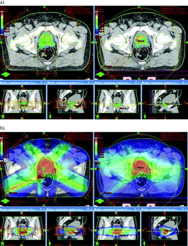 Figure 2.  Dose wash images for the RapidArc plan (right) and the IMRT plan (left) for patient 5. In (a) the lower cut-off level is 95% dose, and in (b) the cut-off level is 5% dose. In both cases, the upper cut-off level is 104.5% dose.