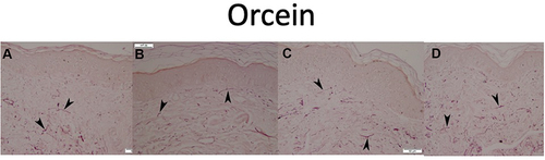 Figure 3 Skin biopsy from striae stained with Orcein (scale 50 μm). (A) Before treatment, (B) after 3 sessions of combined treatment, (C) after 3 sessions of fractional laser/RF, (D) after 3 sessions of PRP. Note the lack of increase in elastin. Black arrows point to elastic fibers.