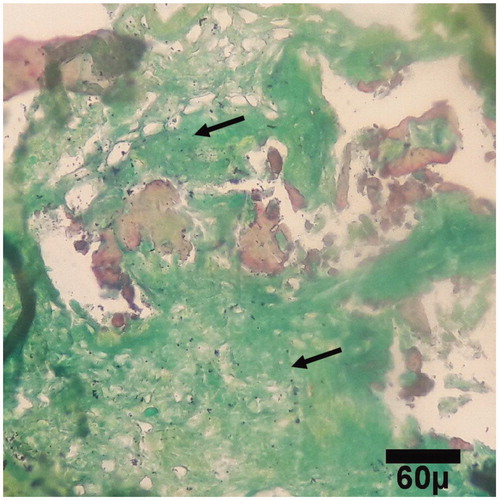Figure 4. Microscopic section from the healing site of sham group on day 30 of healing shows abundant fibrous tissue (arrows) filled marrow space (trichrom ×100).