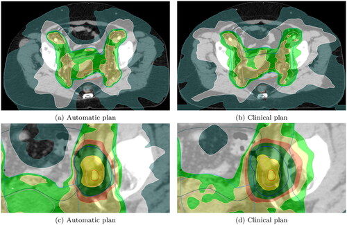 Figure 4. Automatic vs. clinical plans for two different representative patients in (a), (b) and (c), (d). Isodose lines are dark yellow for 55 Gy, dark green for 49.5 Gy, orange for 47.3 Gy, yellow for 45 Gy, green for 42.75 Gy, white for 27.5 Gy, and sea green for 16.5 Gy. PTV is outlined in blue, CTV in pink and GTV in red. The bowel is dark green, the sigmoid is orange, and the rectum is brown.