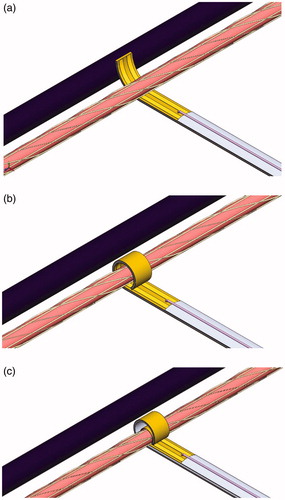 Figure 1. Principle of operation. (a) Nitinol slightly bends to be inserted between a renal artery and vein due to in-vivo temperature. (b) RF generated heat on parallel copper-coated-gold electrodes is conducted to nitinol and reach the superelastic phase to fully recover one loop. (c) By pulling FPCB, the electrode adjusts the diameter of a renal artery.