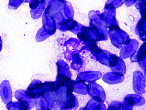 Figure 4.  Cytologic preparation of the right lower eyelid, Eclectus parrot (E. roratus). Foamy macrophage with several, 2 to 5 µm, oval thin-walled yeasts exhibiting narrow-based budding (H. capsulatum) surrounded by a few avian erythrocytes. Diff Quick. 1000x magnification.