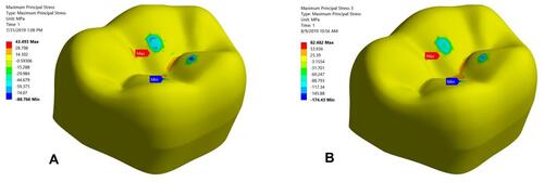 Figure 8 The maximum tensile stress for B groups of Zirconia studied under axial compressive load (A) 50 N; (B) 150 N.