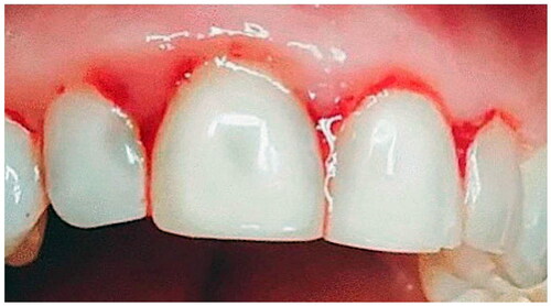 Figure 2. An early stage of periodontitis demonstrates bleeding and puffy gum (from reference [Citation12]).