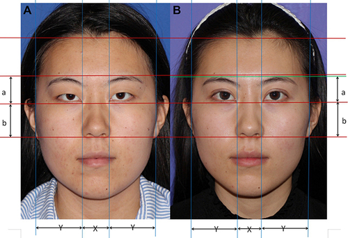 Figure 6 The overall changes before and after surgery Case 2. (A) Before the operation. (B) Six months after upper eyelidplasty.