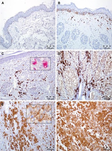Figure 1 FOXP1 expression in skin melanoma patients.