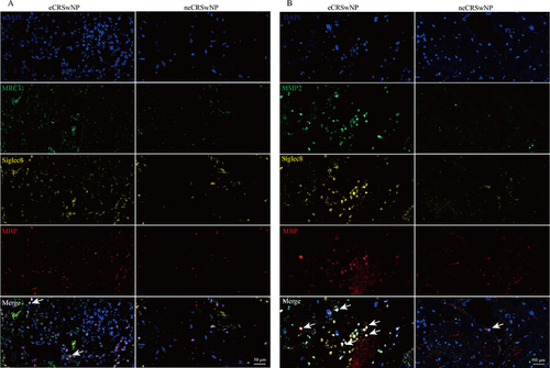 Figure 8 Multiplex immunofluorescence staining exploring the co-expressions of MRC1 (A), MMP2 (B), and eosinophil markers. Cells with evident co-expression are indicated by white arrows.