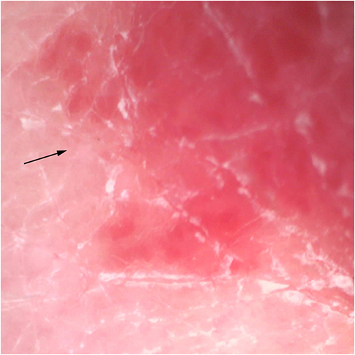 Figure 2 Dermoscopy (amplification ×33) revealed an intensive vascular network. The black arrow indicates the same landmark for comparative dermoscopic observations.