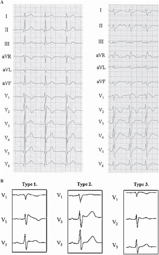 Figure 9. ECG manifestations of Brugada syndrome. A: Both ECGs in this panel demonstrate typical type I (coved type) Brugada syndrome ECG pattern; RBBB-like pattern with distinct ST segment elevation and T wave inversion in the right (V1–3) precordial leads. Additional changes on the right side ECG, such as longer QRS duration and prominent R’ wave in aVR, have been associated to poor prognosis. Paper speed 25 mm/s, gain 10 mm/mV. Reprinted with permission from Junttila MJ et al. Differences in 12-lead electrocardiogram between symptomatic and asymptomatic Brugada syndrome patients. J Cardiovasc Electrophysiol. 2008;19:380–3. Wiley-Blackwell Publishing. © B: Brugada syndrome subtypes are shown. Left: Typical type I (coved type) Brugada syndrome ECG pattern. Middle: Type II (saddleback) Brugada ECG pattern. The T waves in the right precordial are upright, differentiating it from type I. Right: Type III Brugada ECG pattern. Similar changes to that of type II, but with minimal (< 0.2 mV) ST segment elevation. Paper speed 50 mm/s, gain 10 mm/mV. Reprinted with permission from Junttila MJ et al. Prevalence and prognosis of subjects with Brugada-type ECG pattern in a young and middle-aged Finnish population. Eur Heart J. 2004;25:874–8. Oxford University Press. ©