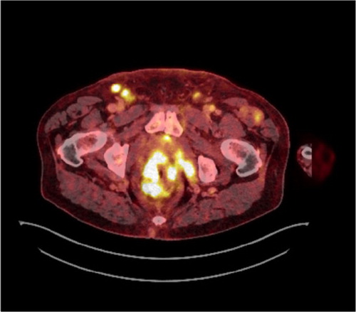 Fig. 3 Abdominal PET-CT scan showing a rectal mass, moderate quantities of ascites, and enlarged lymph nodes in pelvis and groin.