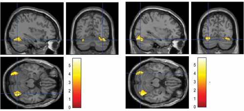 Figure 1. Significant right (left panel) and left (right panel) cerebellar clusters showing decreased 18F-FDG PET metabolic connectivity with precuneus after EMDR, projected onto MRI slices, spatially normalized into the standard SPM template. The right and left cerebellar cluster involve both the Crus I and VI cerebellar lobules at respective T-max voxel of 5.8 and 5.3.