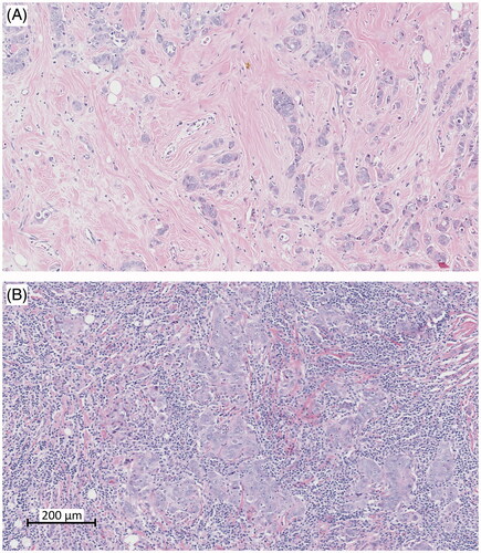 Figure 1. Hematoxylin–eosin (HE) staining’s showing examples of tumors with (A) low level of stromal tumor-infiltrating lymphocytes (TILs) and (B) high level of TILs using a cut off of 30%.