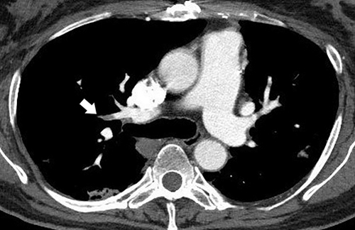 Figure 2 Computed tomography. Day 19 after symptom onset. The arrow shows a pulmonary embolus in the right upper lobe on contrast CT.