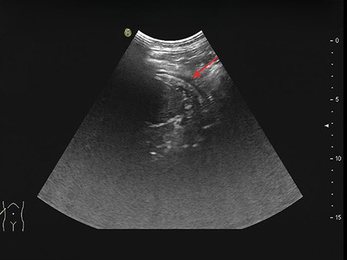 Figure 3 Follow-up chest ultrasound indicated a small pleural effusion (as shown by the red arrow) after 4 weeks.