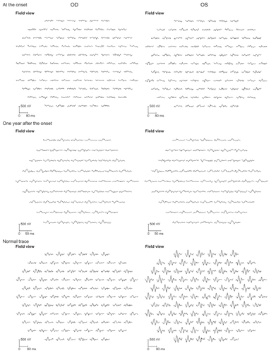 Figure 4 Multifocal electroretinographics (ERGs). At the onset, the multifocal ERGs are reduced in the right eye. At the 1 year follow-up examination, the multifocal ERGs have improved but are still reduced especially from the temporal retina. Shorter duration protocol with 61 hexagonal elements was used for the latest recording, because acceptable responses to 103 hexagonal elements could not be obtained due to fatigue of the patient during the recording.