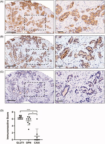 Figure 2. Immunohistochemical detection of GLUT1, OPN, and CAIX expression in prostate cancer tissue. (A) Representative images of moderate GLUT1 staining, (B) moderate OPN staining, and (C) negative CAIX staining in serial sections of biopsy ‘a’ from patient #5. Boxed regions in the left images are enlarged on the right. Scale bars = 200 µm (left) or 50 µm (right). (D) Immunoreactive scores (IRS) were calculated for each patient by averaging IRS values for GLUT1, OPN, and CAIX IHC staining from 2 to 3 biopsies per patient. Data are mean ± SD (n = 8, *p < 0.05, ***p < 0.001, Kruskal–Wallis test with Dunn’s post-hoc analysis).