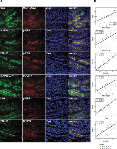 Figure 7. The relevance of the hypoxia/autophagy/EZR pathway in human TICs. (A) Immunofluorescence staining and colocalization in human tumor tissues (from six patients) for CA9 (a downstream target of HIF1A), BNIP3L, MAP1LC3A, p-EZR, and POU5F1 (refer to Fig. S7 for patient characteristics including TNM staging and HE stainings). The specificity of all used antibodies was carefully validated (please see Material and Methods and Supplementary data). Scale bar: 100 µm. (B) Staining correlation in human CRC tissues. Measures were standardized (z-score) for each patient. Dot colors indicate different patients. A repeated measure correlation test was performed in order to account for the within-individual association of paired measures (using the rmcorr package in R; see Material and Methods). The rmcorr r coefficient and the Holm adjusted p-values are reported on each plot.