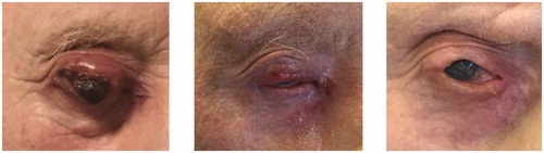 Figure 3. Affected eyelid before (left), at the end of (middle), and 6 months after radiotherapy (right).