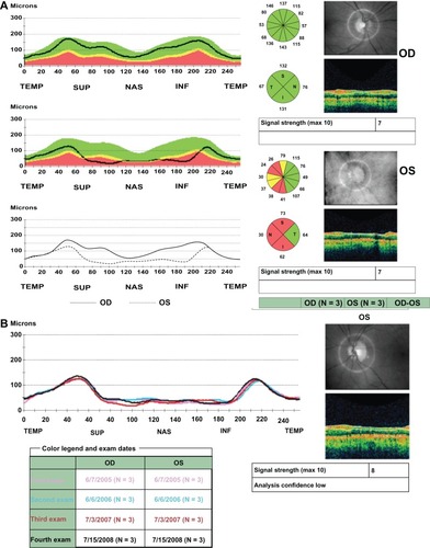 Figure 3 A 52-year-old woman developed an acute event of nonarteritic anterior ischemic optic neuropathy in her left eye. Her visual acuity in that eye was 20/20, color vision was decreased and there was a positive left relative afferent pupillary defect. The right eye was uninvolved. (A) Retinal nerve fiber layer thickness analysis report approximately 6 months after the acute event. In the right eye, the retinal nerve fiber layer is within normal limits in all sections of the optic nerve head and in the left eye there is severe retinal nerve fiber layer loss save for the temporal quadrant. This patient was followed annually with an optical coherence tomography scan performed on each visit. (B) Serial analysis report demonstrating stability of the retinal nerve fiber layer thickness in the involved eye over time.