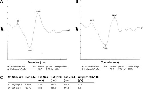 Figure 2 Visual evoked potential of a patient with COPD.