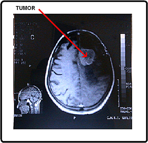 Figure 1. CT scan image of brain tumor.
