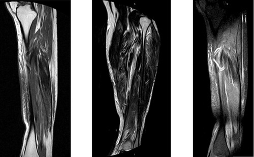 Figure 3 Magnetic resonance imaging showing sequelae at 6 months.