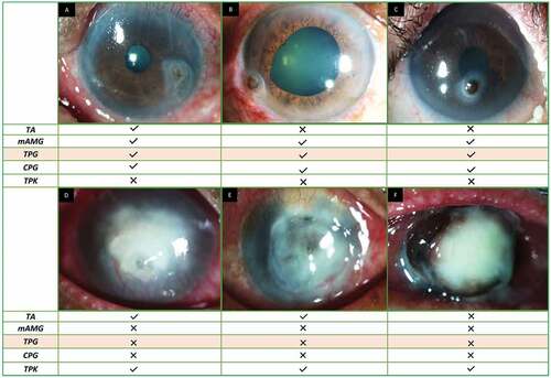 Figure 2. Different types of corneal perforations and the various modalities that can be employed in their management. a) Paracentral small sterile perforation b) Peripheral large sterile perforation c) Central sterile perforation with shallow fornices in Stevens-Johnson syndrome d) Central perforation with microbial keratitis with active infiltration e) Central large perforation with microbial keratitis with significant collagenolysisf) Total corneal melting with pseduocornea formation. TA: Tissue adhesive, mAMG: multilayered amniotic membrane graft, TPG: tenon's patch graft, CPG: corneal patch graft, TPK: therapeutic penetrating keratoplasty.