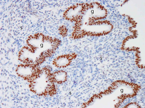 Figure 3. Image of progesterone receptor (PR) immuno-reactivity in human endometrium after administration of a selective PR modulator (SPRM). Note intense positive (brown) immunostaining in the glandular epithelium (g) and virtual absence of immuno-reactivity in the stroma (s). Image kindly provided by Professor Alistair Williams, University of Edinburgh. Full color available online.