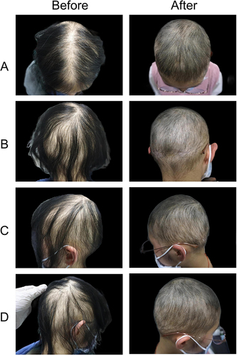 Figure 2 Photographs of a representative patient in the traditional group: panel A-D showed different regions of scalp before and after treatment ((A) top, (B) posterior, (C) left side, (D) right side).