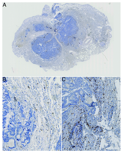 Figure 1. Colorectal cancer lung metastasis. A) shows an overview image with the central metastatic site and surrounding normal lung tissue. B) shows a 10x magnification of a region within a metastatic lesion with a low density but more homogeneous distribution of stained immune cells (CD3+ cells stained) and C) shows a more heterogenous distribution of stained immune cells (CD3+ cells stained, distribution skewness near zero)